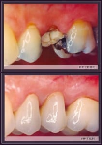 Tooth Extractions