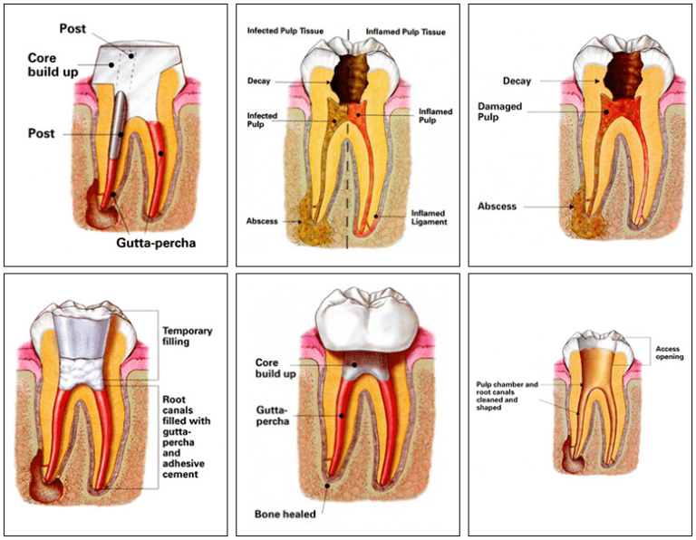 Root Canals Moore Family Dentistry