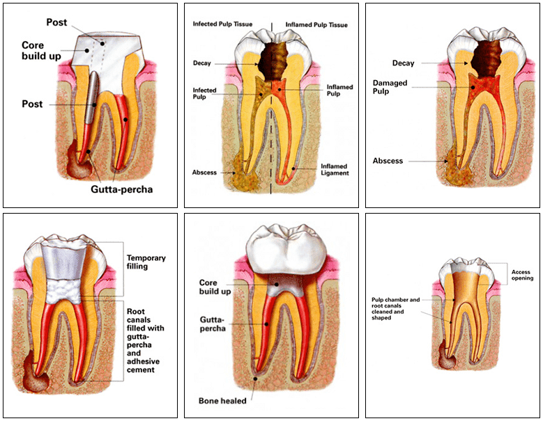 Root Canal Procedure