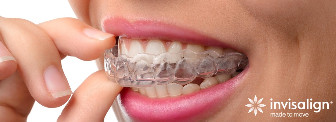 invisalign-adult-clear-braces