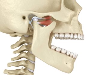 Computer graphic of the profile of a skull with the inflamed temporomandibular joint disorder highlighted.