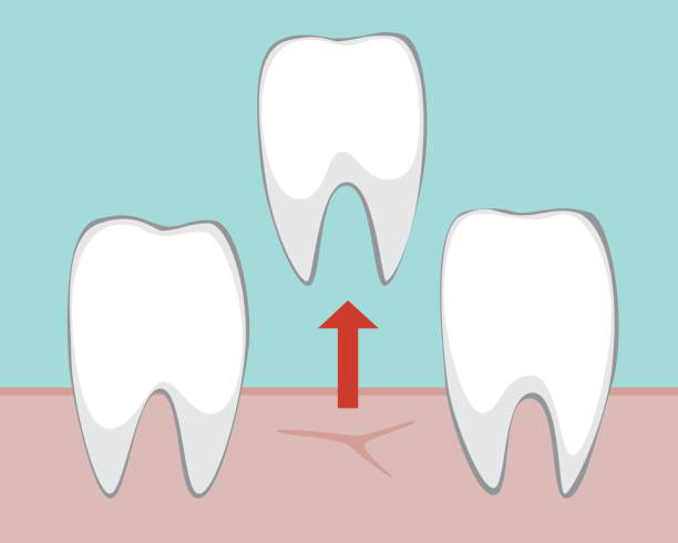 Simple graphic of three teeth, with one being lifted up and out of the gum.