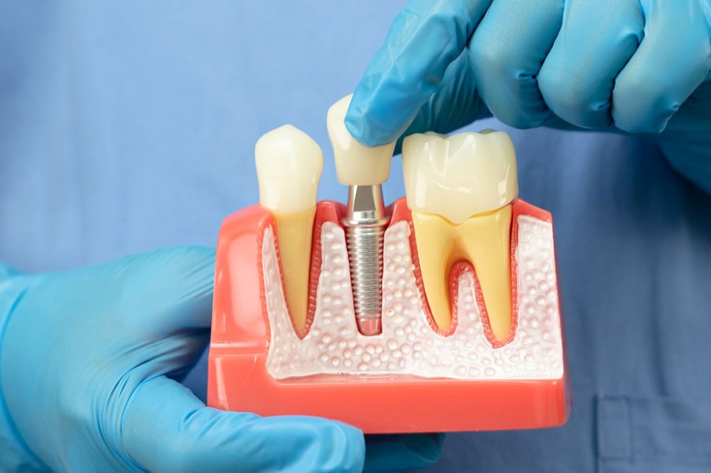 A pair of hands in rubber medical gloves holds a model of a bisected lower jaw, demonstrating what the dental crown procedure is like.